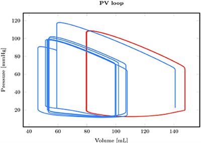 Mechanical circulatory support in ventricular arrhythmias